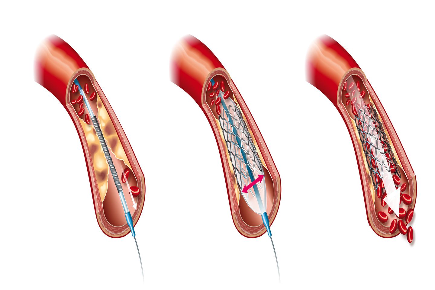 Bioresorbable